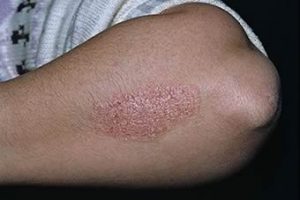 PSORIASIS TREATMENT