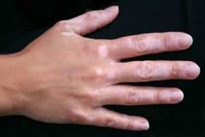 VITITLGO