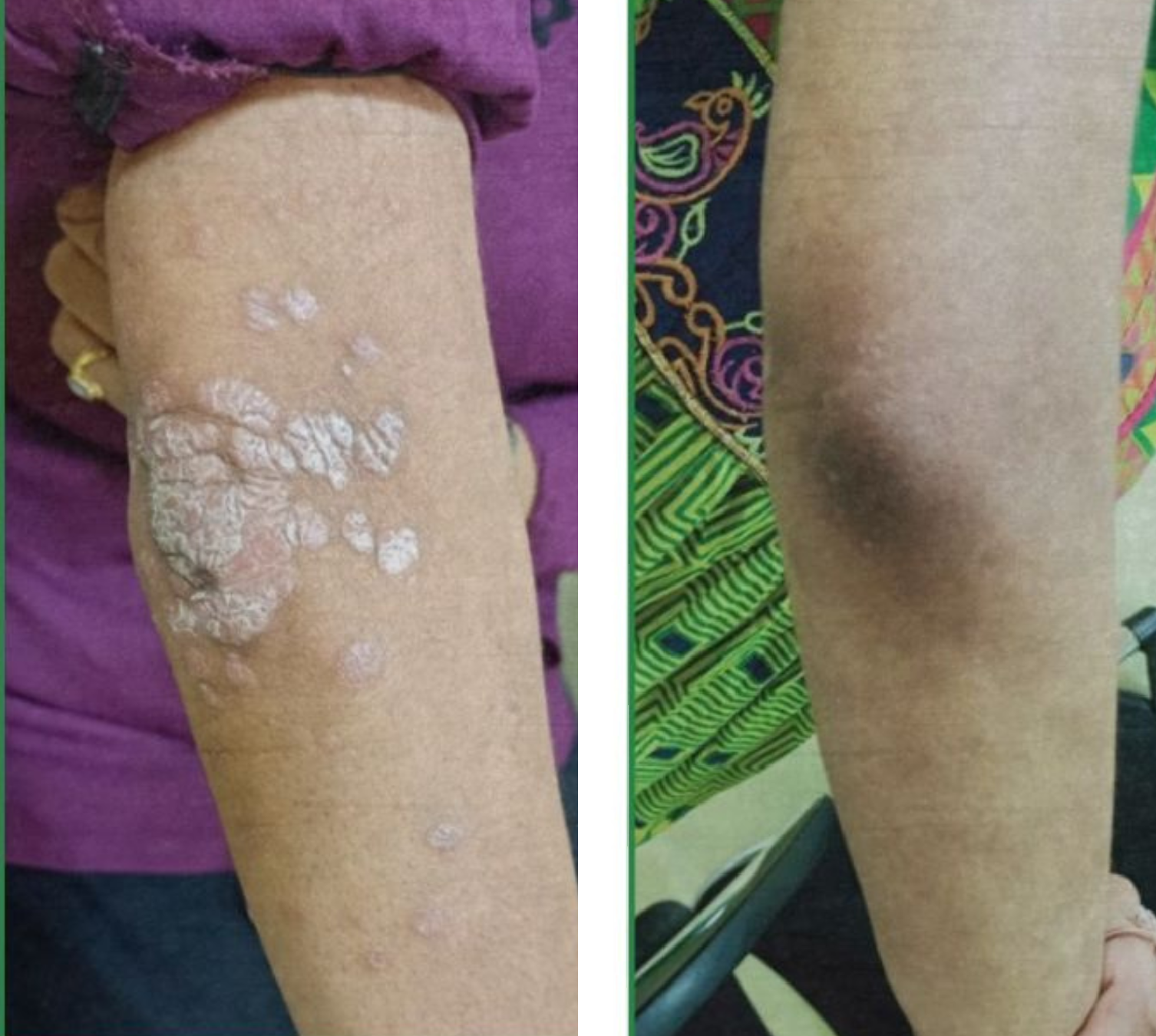 Psoriasis before and after