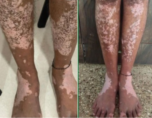 Vitiligo before and after