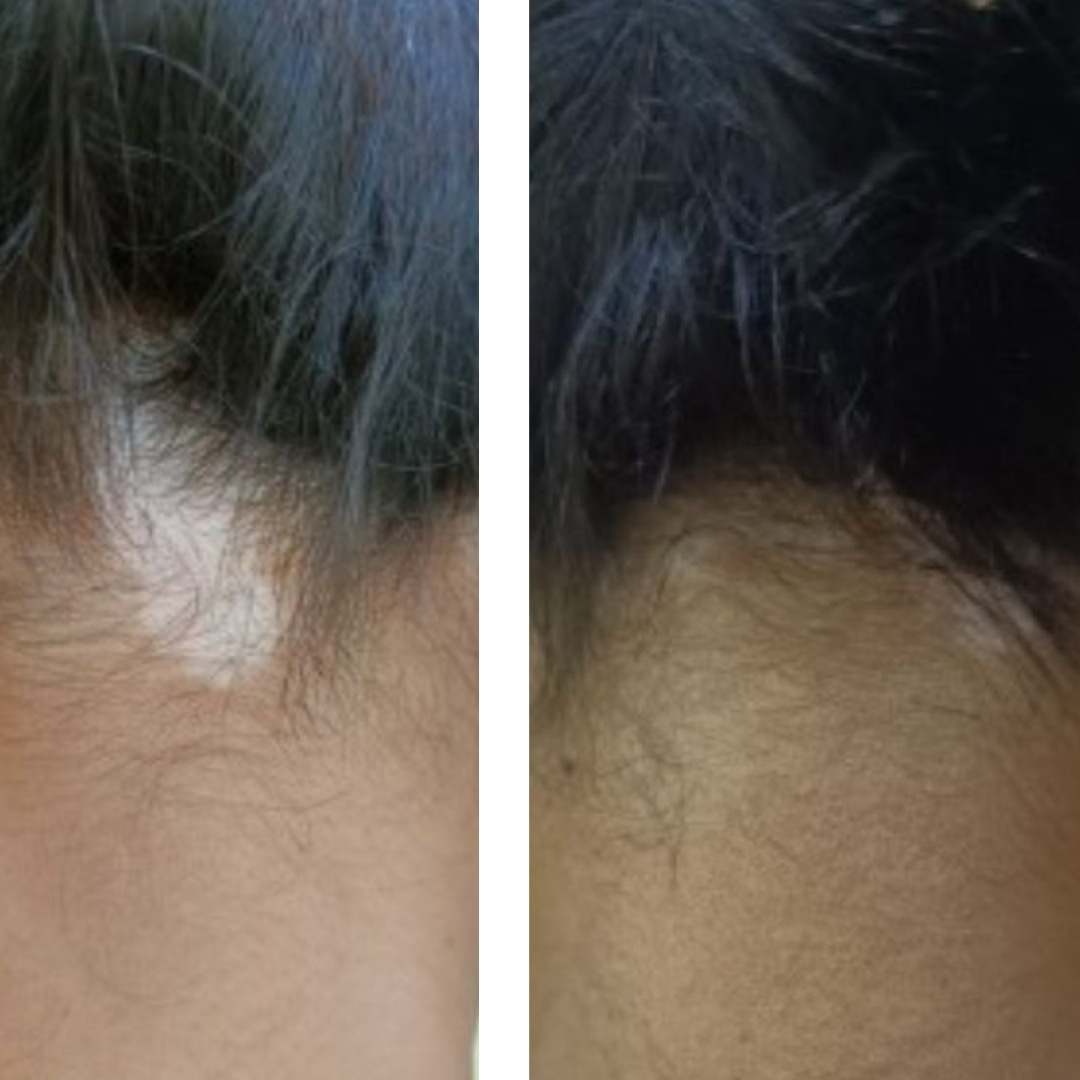 Vitiligo recovery