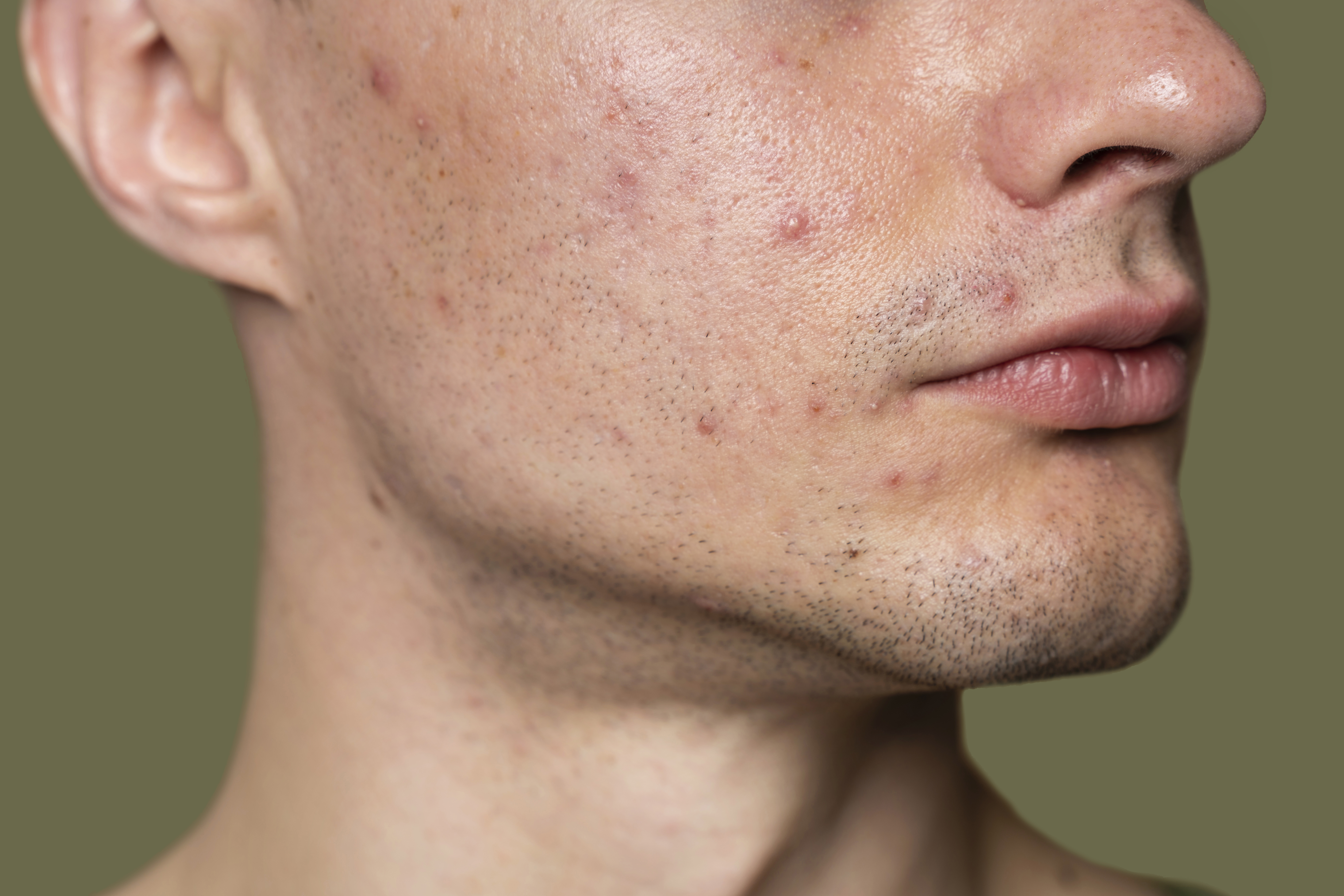 Acne Management