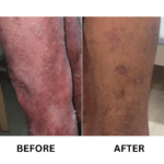 psoriasis treatment in Aurangabad – before and after