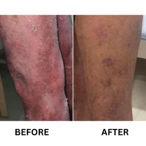 Psoriasis