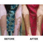Vitiligo Treatment (4)