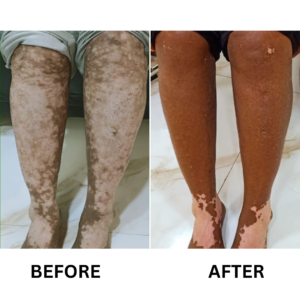 Vitiligo