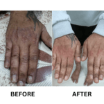 Vitiligo Treatment (6)