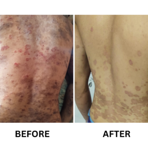 Psoriasis​