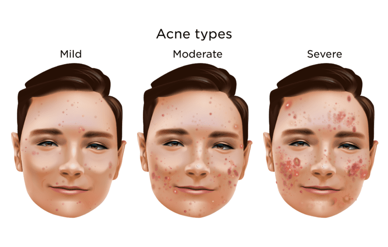 acne